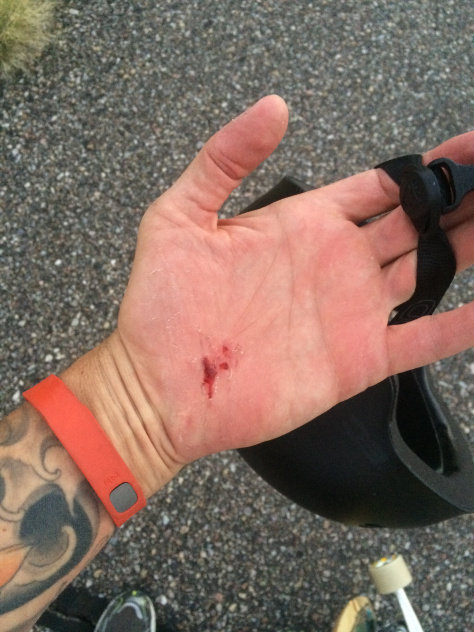 img_0350 All too common "road rash." Wear gloves...or don't fall. Either way is good for your skin.